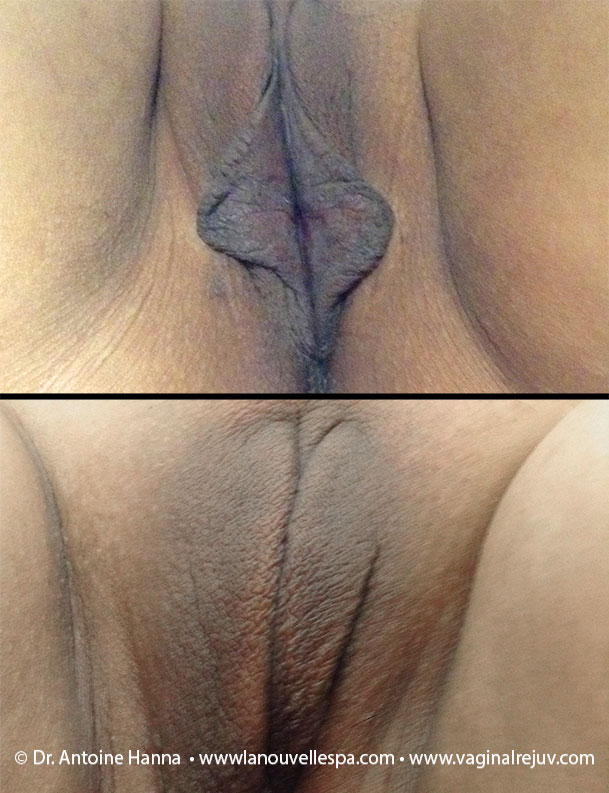 labiaplasty labia reduction before and after photos by dr. Hanna, La Nouvelle Medical Center, Oxnard, Ventura County